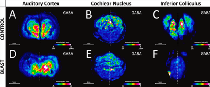 Six brain scan intensity maps show concentrations of a naturally occurring neurotransmitter. 