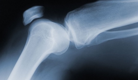 Photo of an x-ray of a knee. 
